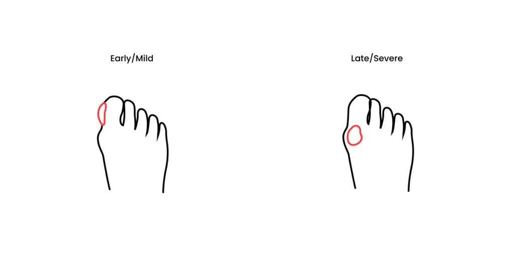 Callus Formation