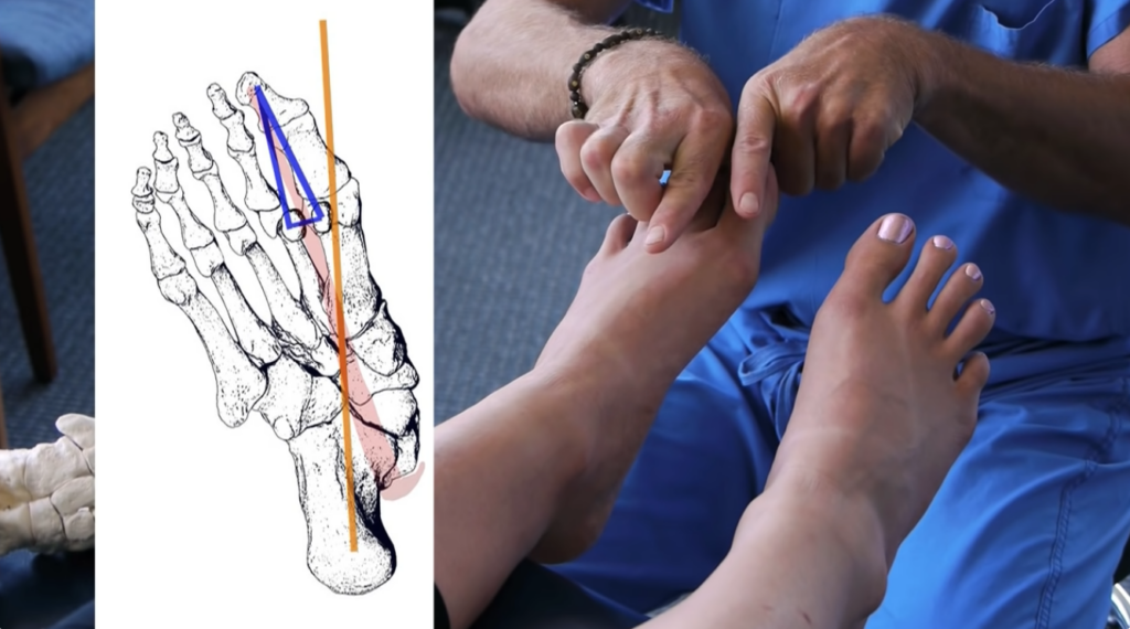 visualization of big toe in inward position compared to its natural position 